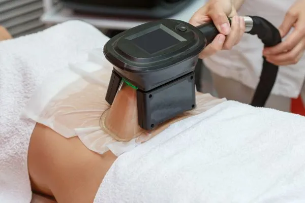 Image of person having fat freezing treatment to help weight gain Solihull