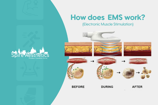 EMS treatment for post pregnancy weight loss treatment Solihull
