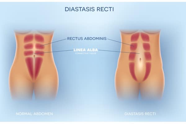 What Non-Surgical Options Are Available for Diastasis Recti Solihull?
