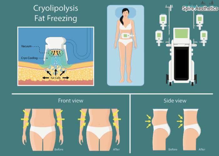 Image of diet and fat freezing combined for best results for Spire Aesthetics Solihull