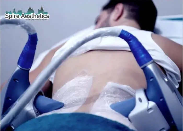Man having fat freezing treatment done on love handles before a competitions Solihull to create a sculpted look.