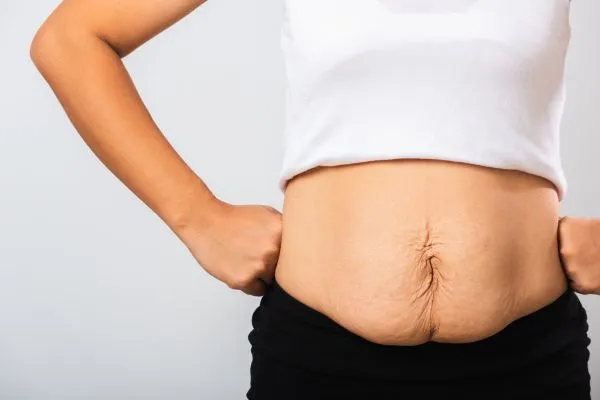 Image of a woman's stomach after weight loss with sagging skin following a gastric band Solihull