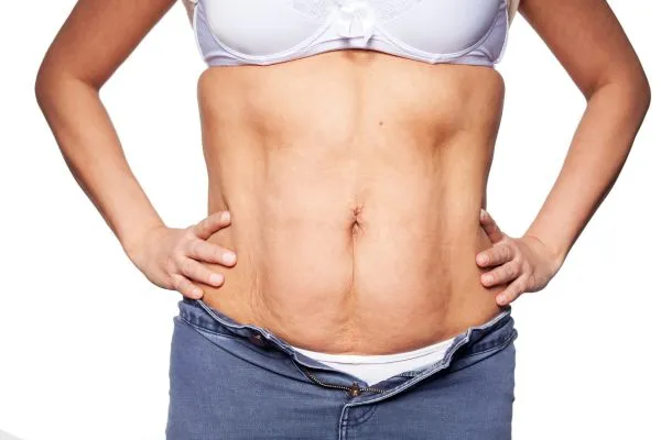 sagging skin on woman's stomach after weight loss injections Solihull