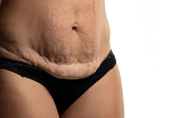 Image of womans stomach after weight loss injections Solihull showing saggy skin