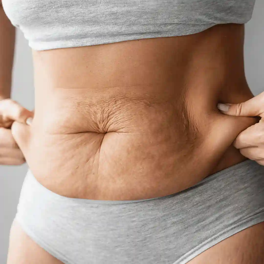 Is It Normal to Have Loose Skin After Pregnancy Solihull?