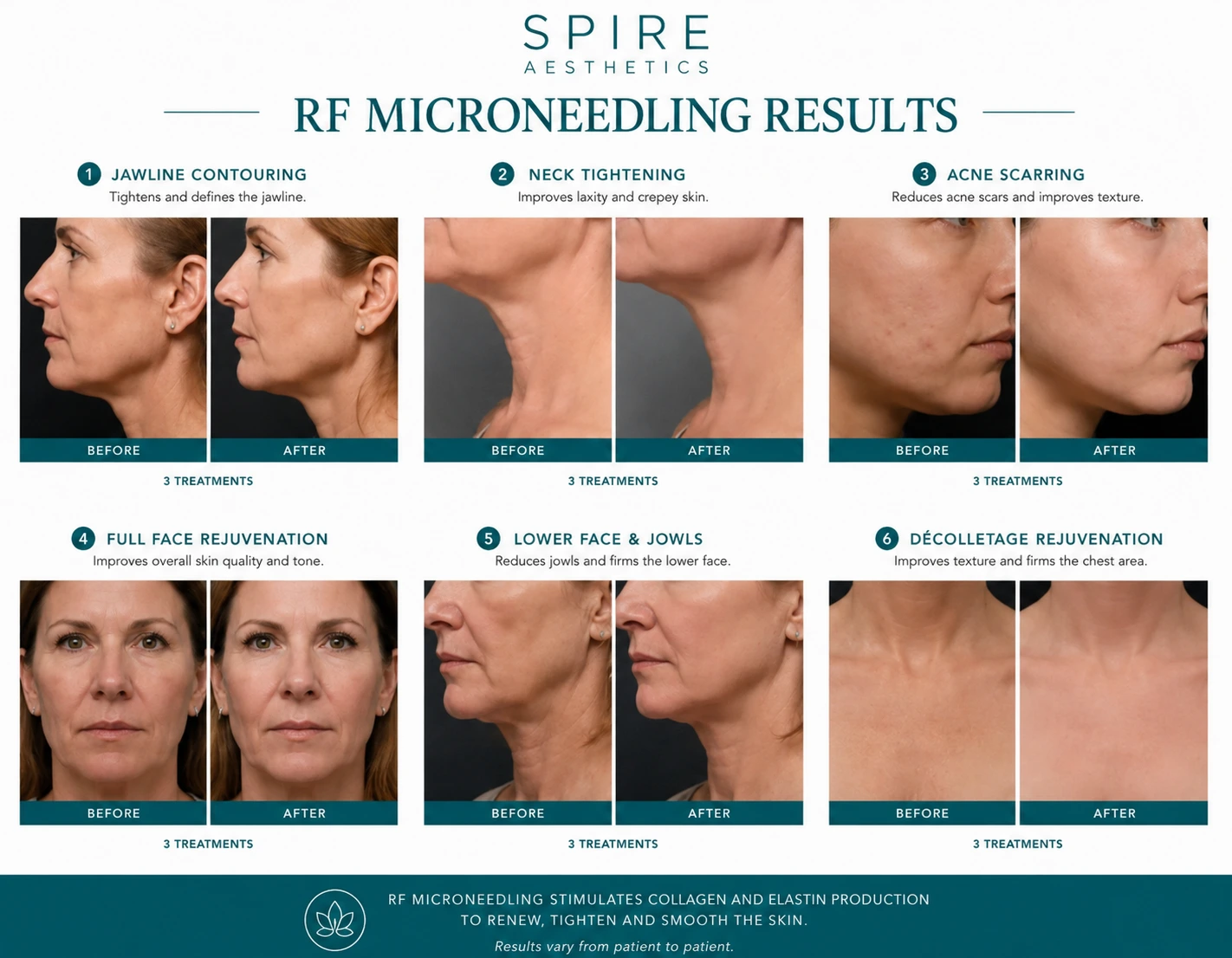 RF Microneedling Skin tightening Solihull results