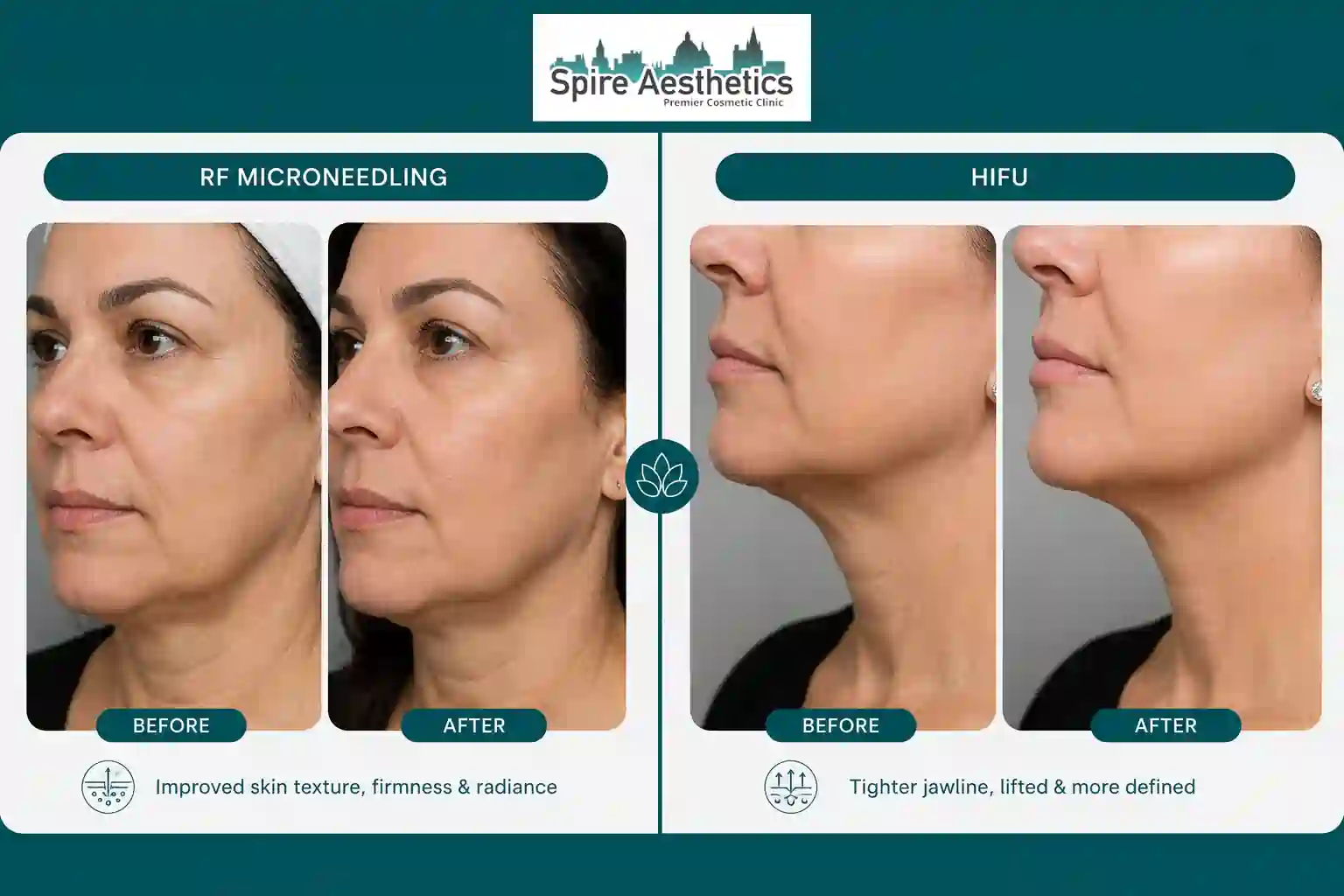 Can RF Microneedling and HIFU Be Combined Solihull?