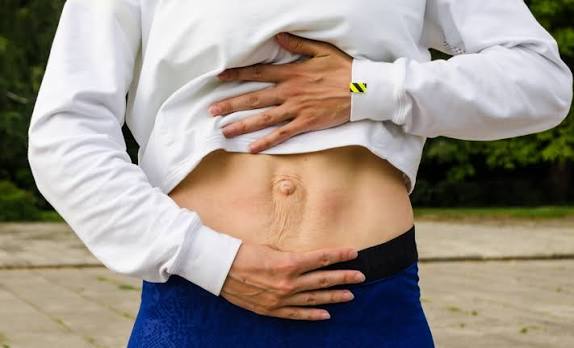When Could Diastasis Recti Be the Missing Piece of the Puzzle Solihull?