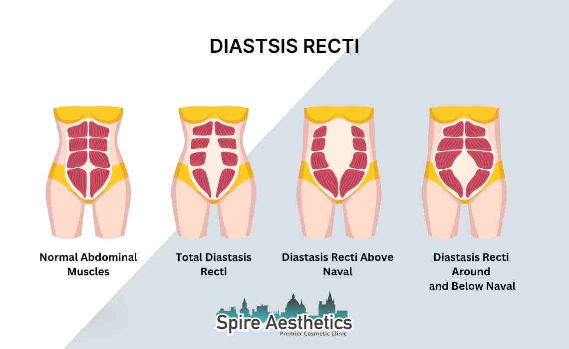 Is Non-Surgical Diastasis Recti Treatment Right for You? Common Concerns Answered Solihull